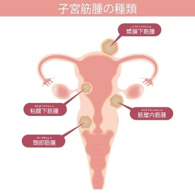 子宮筋腫、卵巣腫瘍